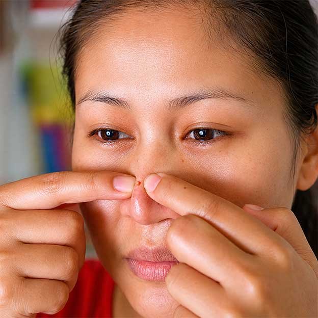 Acne Treatment at AZ Esthetics