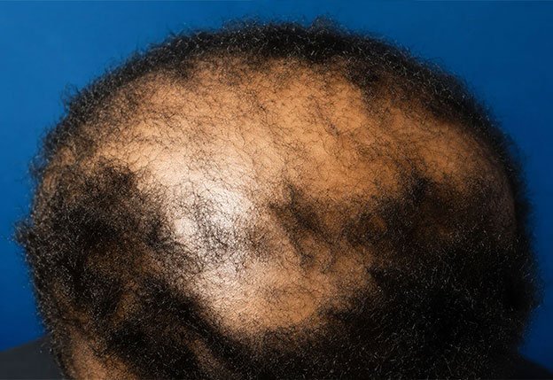 Age Spots, Moles & Skin Tags at AZ Esthetics