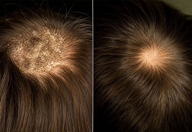 Age Spots, Moles & Skin Tags at AZ Esthetics