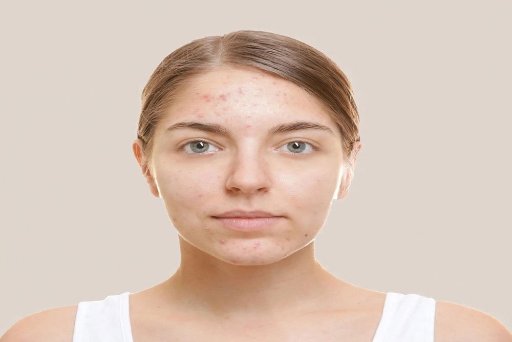 HydraFacial before treatment