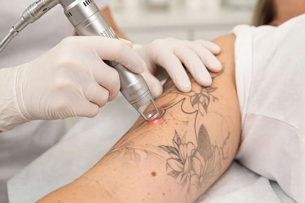 Advanced laser tattoo removal treatment