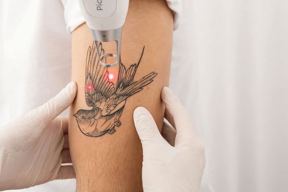 Tattoo removal consultation and treatment at AZ Esthetics