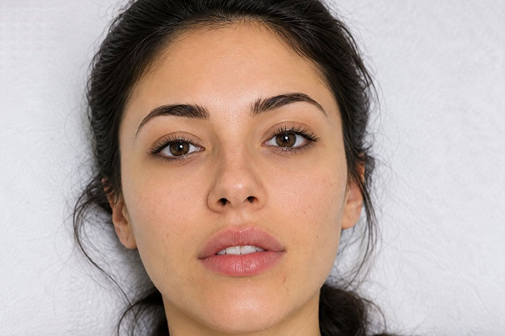 Lip Booster before treatment