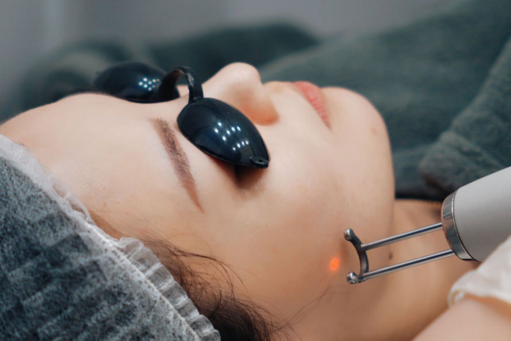 Acne Treatment at AZ Esthetics