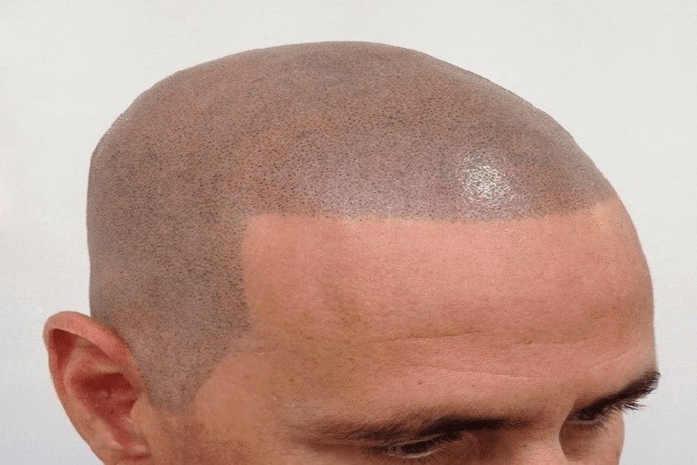 Scalp Pigmentation after treatment