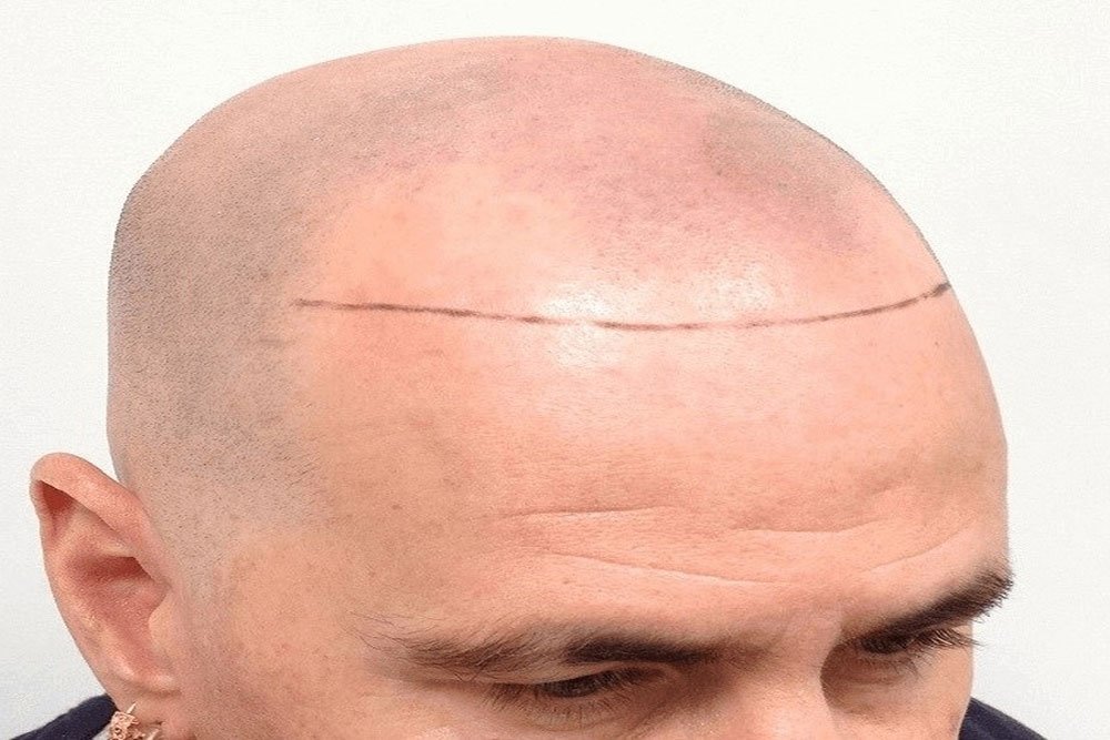 Scalp Pigmentation before treatment